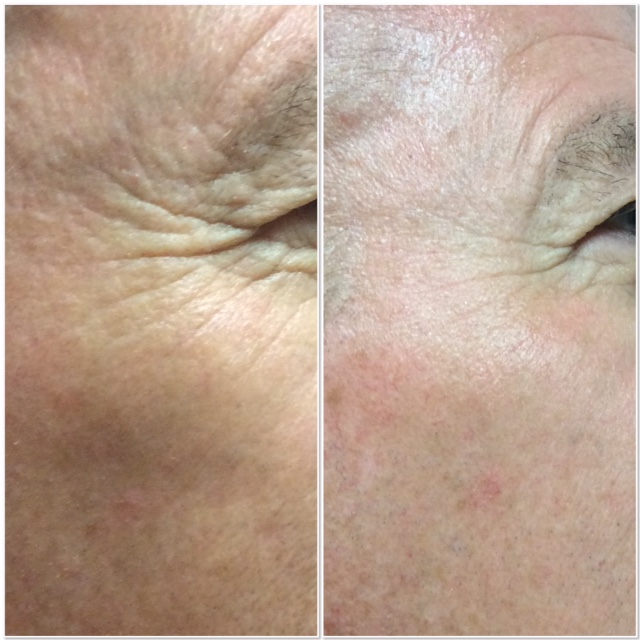 WRINKLE REDUCTION Phoenix Tattoo Removal